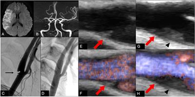 A Case of Ischemic Stroke With Congenital Protein C Deficiency and Carotid Web Successfully Treated by Anticoagulant and Carotid Stenting